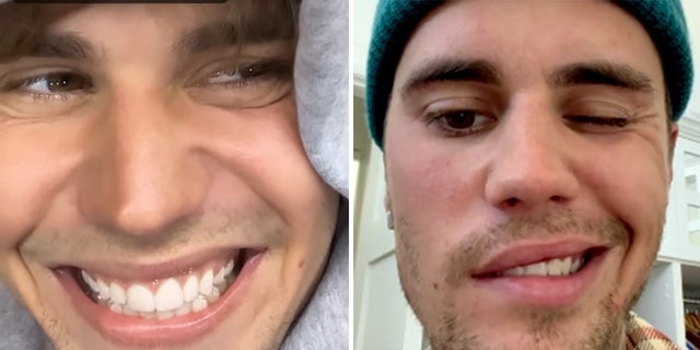 Justin Bieber split photo health conditions
