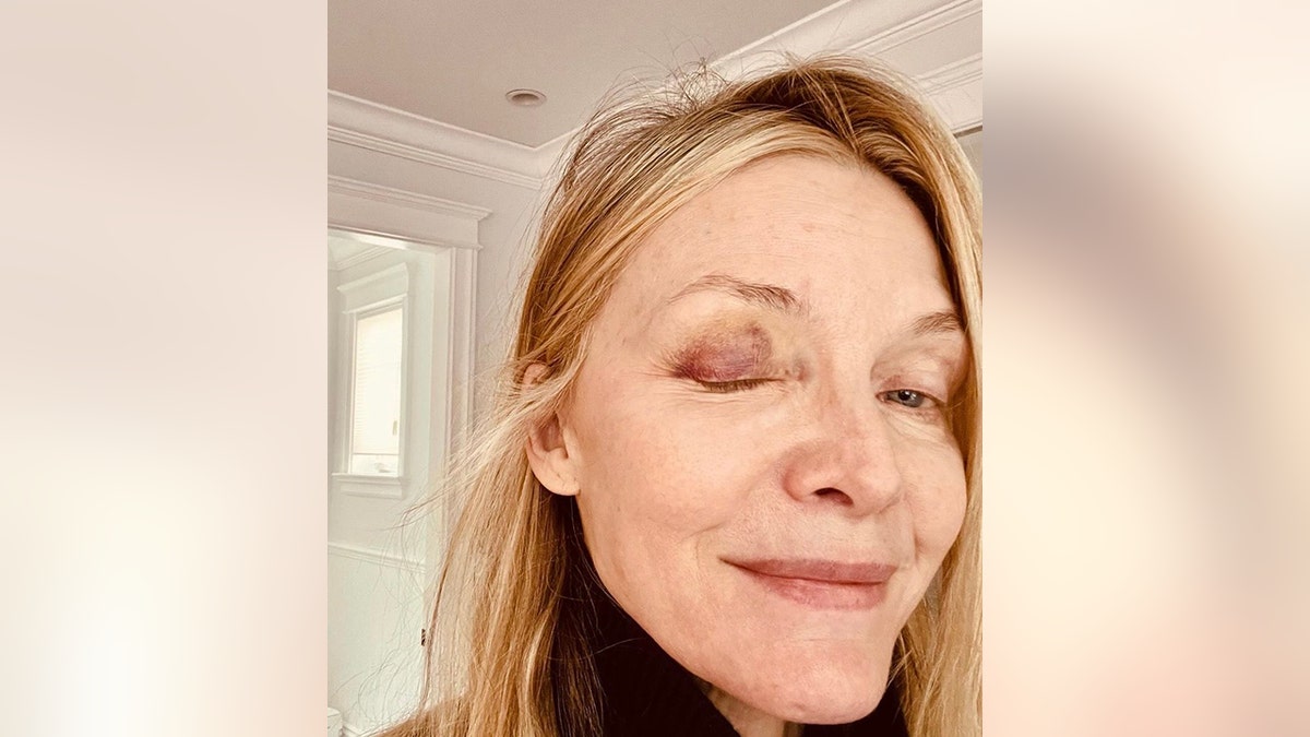 Michelle Pfeiffer shows off one of her bruised eyelids in a selfie